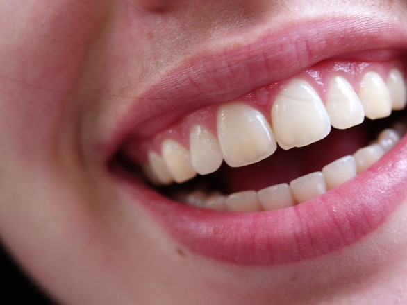 歯垢と歯石は違いがあるの？つかないようにする方法