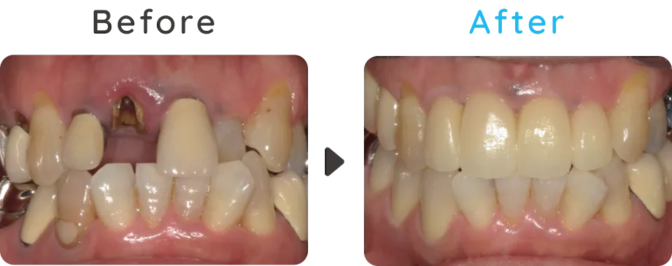 Before After01