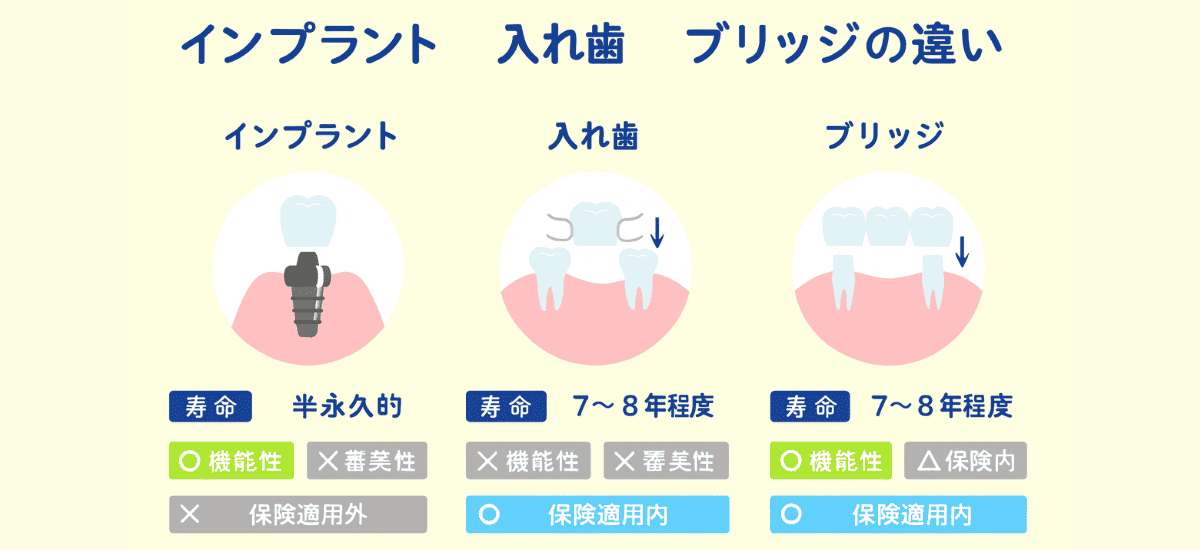 インプラント・ブリッジ・入れ歯の違い